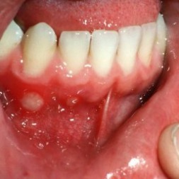 آفت دهان ؛ مزاحمی آزاردهنده| ۲۶ روش درمانی برای مقابله با آفت آفت دهان ؛ مزاحمی آزاردهنده| ۲۶ روش درمانی برای مقابله با آفت