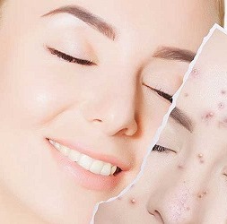 جوش در نقاط مختلف بدن چرا اتفاق میافتد؟ + راه درمان جوش در نقاط مختلف بدن چرا اتفاق میافتد؟ + راه درمان